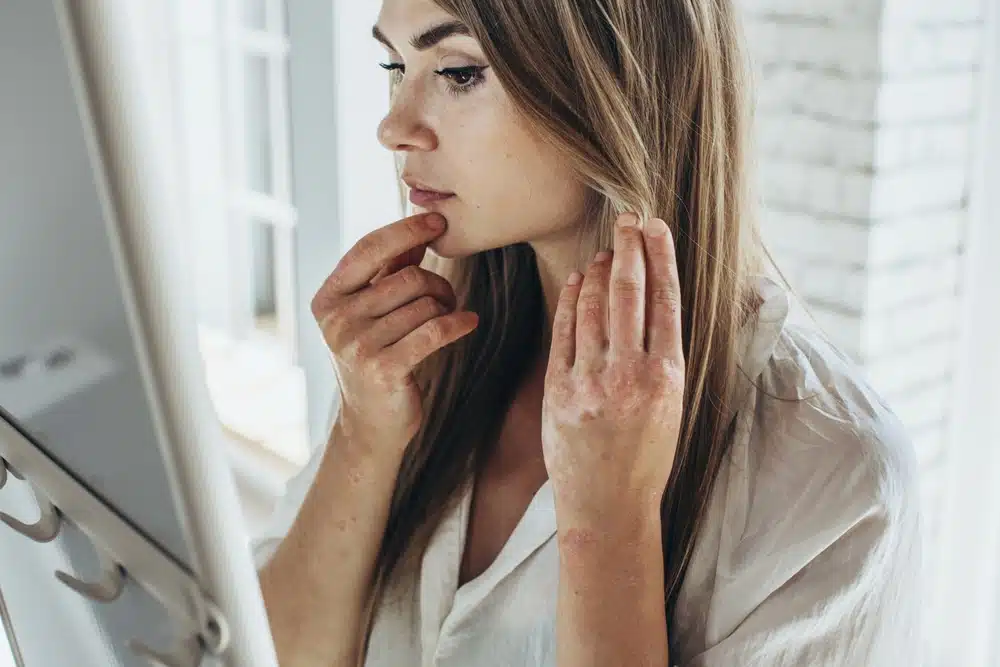 hormones autoimmune fatigue